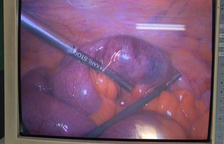 Желчнокаменный илеус. Хирургическое вмешательство выполнено лапароскопически, второй этап произведён из мини-доступа