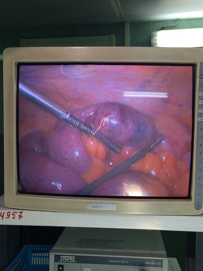 Желчнокаменный илеус. Хирургическое вмешательство выполнено лапароскопически, второй этап произведён из мини-доступа